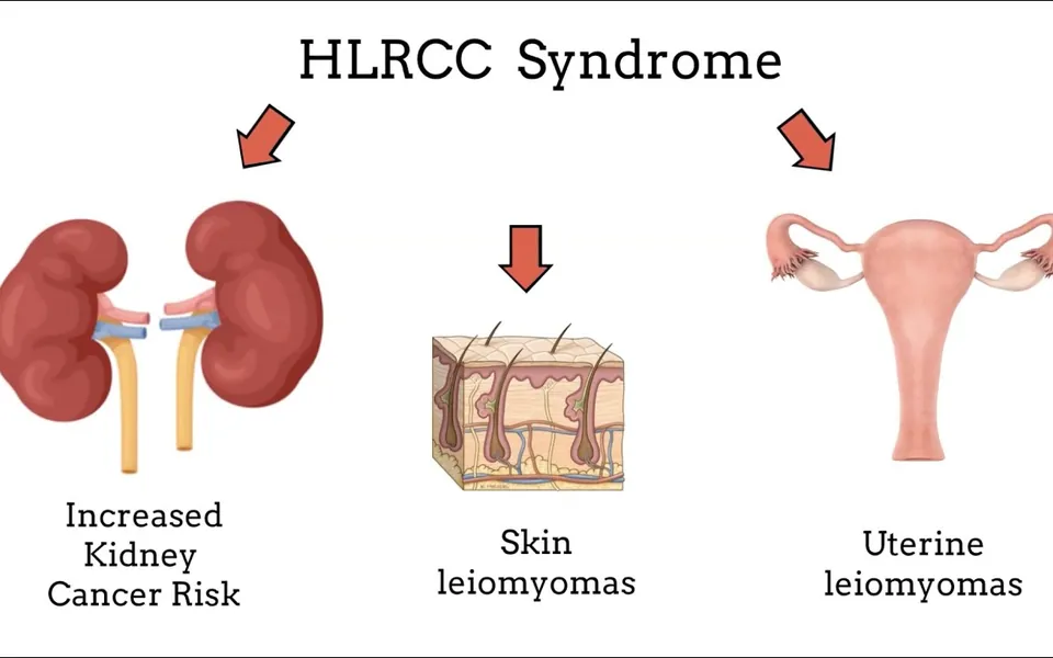 Video still titled HLRCC Syndrome, showing kidneys, skin and uterus